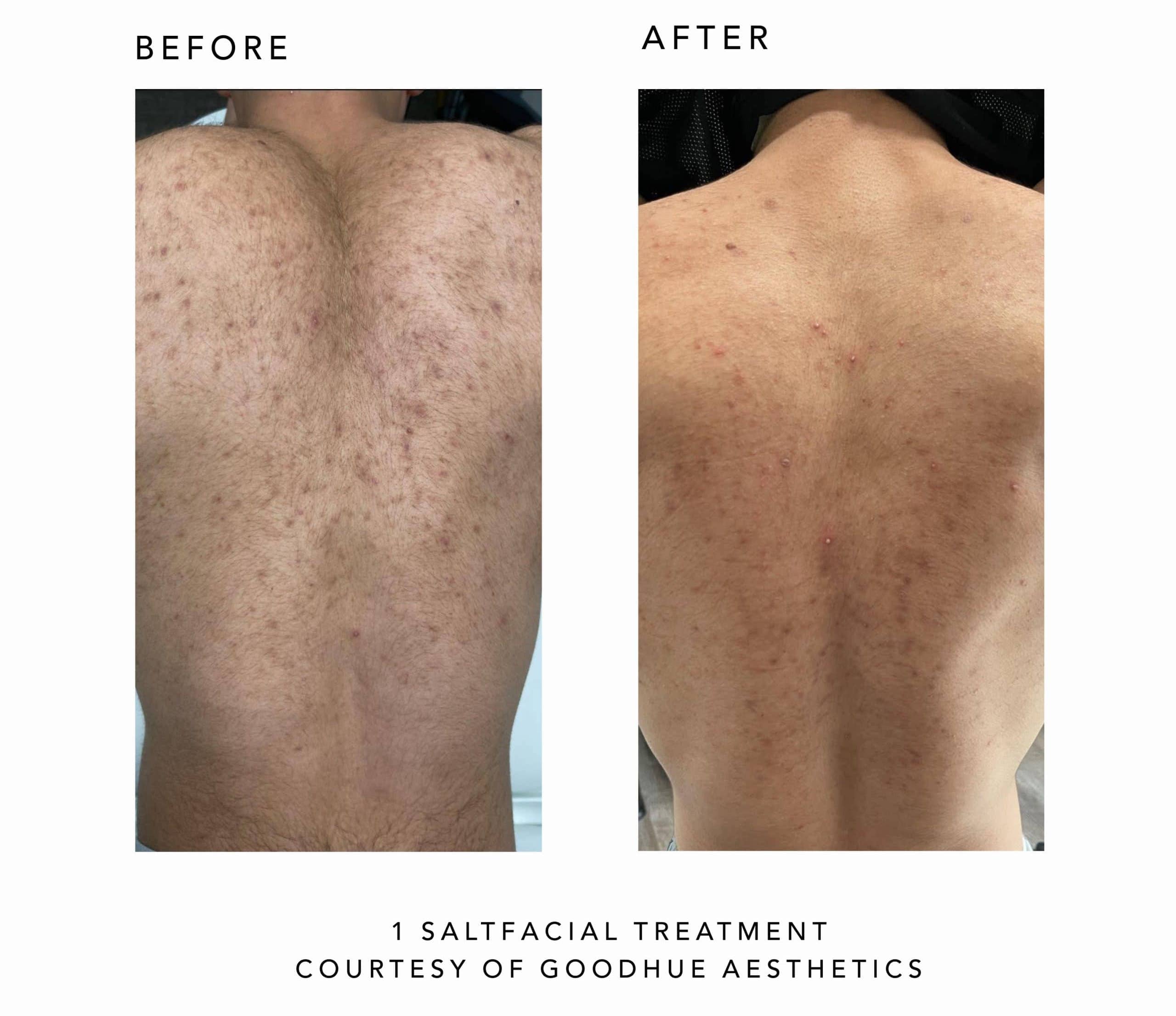 Quick Skin Revival with Saltfacial at Body Goal Medspa