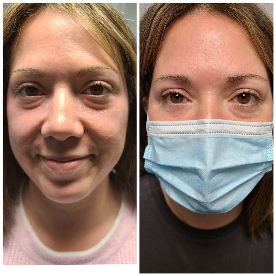 before-and-after-skin-tightening