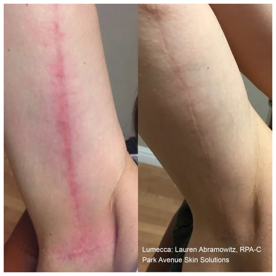 laser-stitching-wound