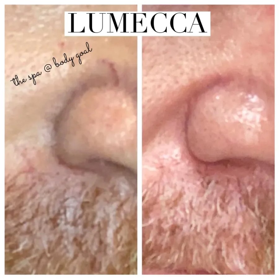 lumecca-men-skin-tightening