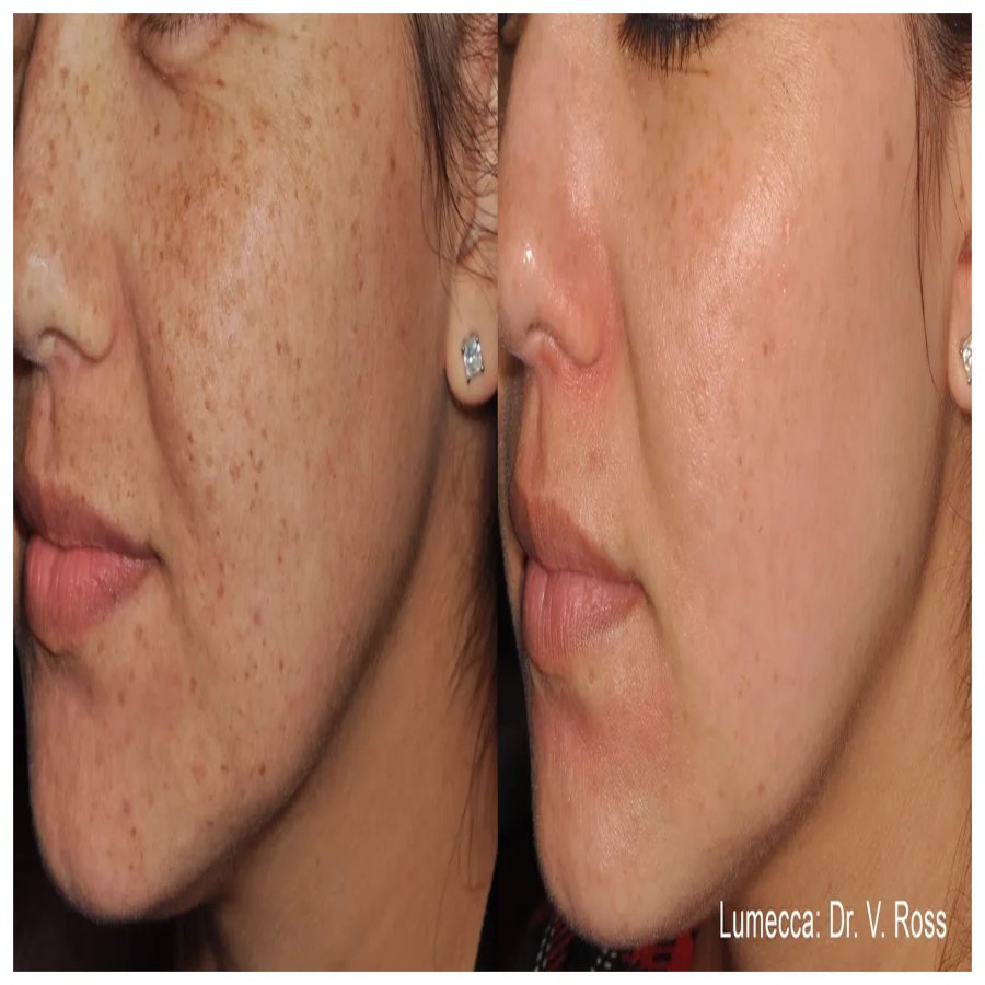 saltfacial-skin-treatment